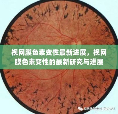 视网膜色素变性最新研究与进展进展报告